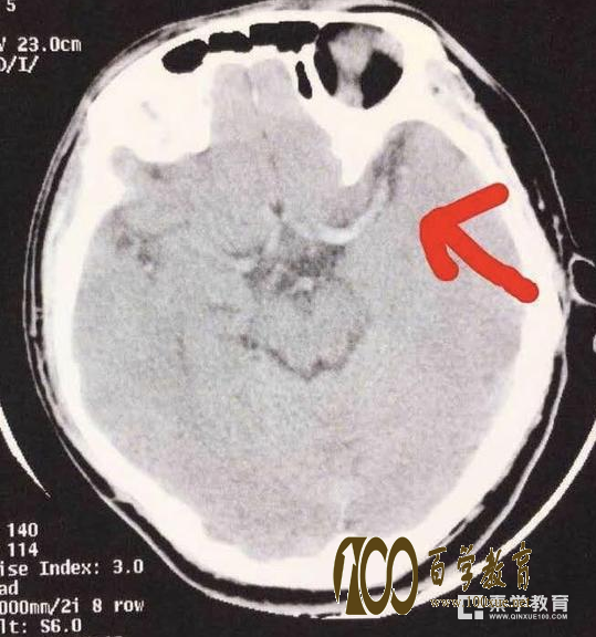 长沙一大学生国庆长假打游戏3天3夜致脑中风!医生提醒每天应保证8小时睡眠!