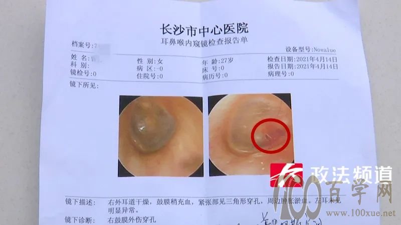 疼!女子在华夏良子采耳导致鼓膜穿孔